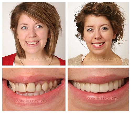 Gum contouring: How does this new gummy smile treatment work?