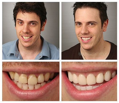 Gum Contouring and Whitening - London Smile